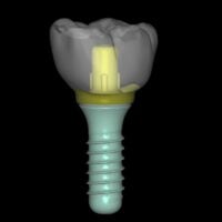 Crowns, Bridges & Implants