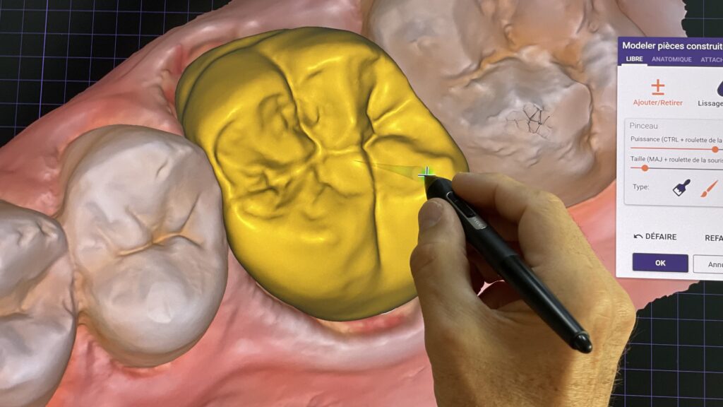 Crown design in Geneva by Swiss 3D Dental Design
