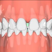Aligner Refinement