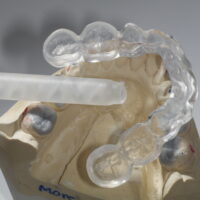 Splint for Wax-Ups