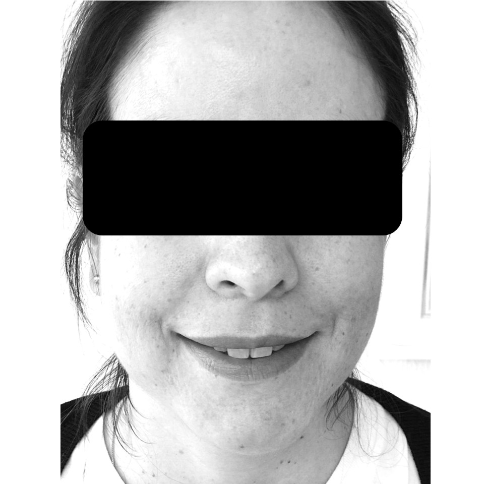 Aligner 1-10 Steps - Image 3