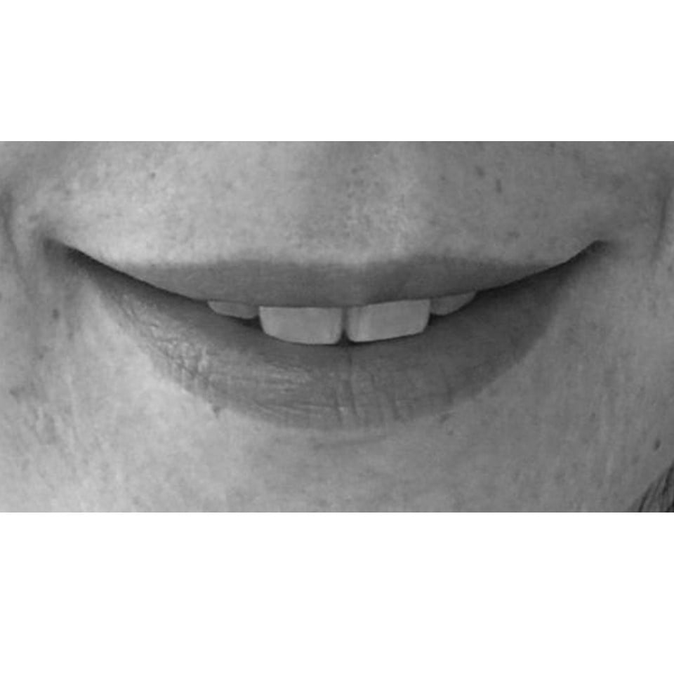 Aligner 1-10 Steps - Image 4