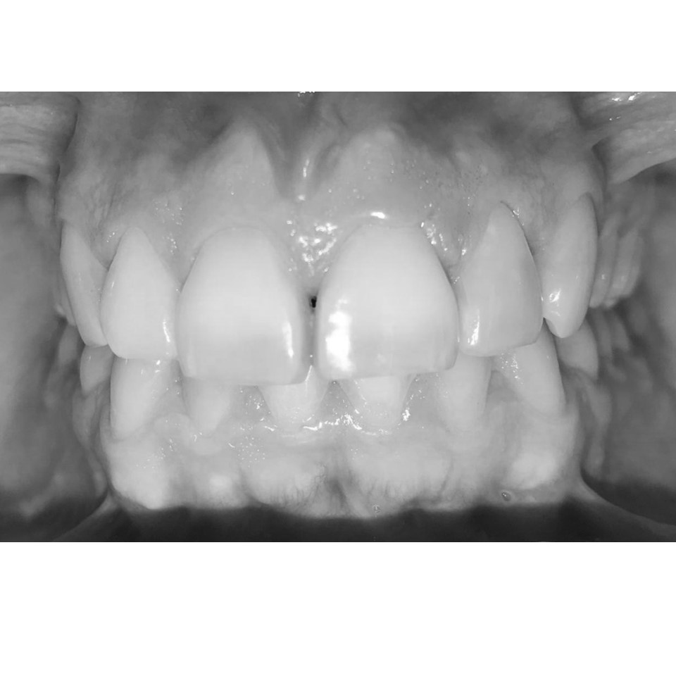 Aligner 1-10 Steps - Image 5