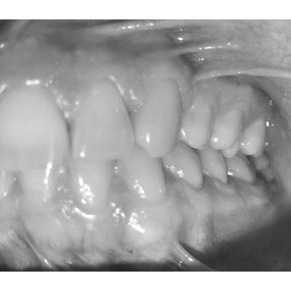 Aligner 1-10 Steps - Image 7