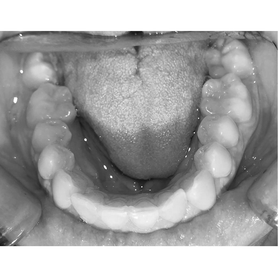 Aligner 1-10 Steps - Image 9