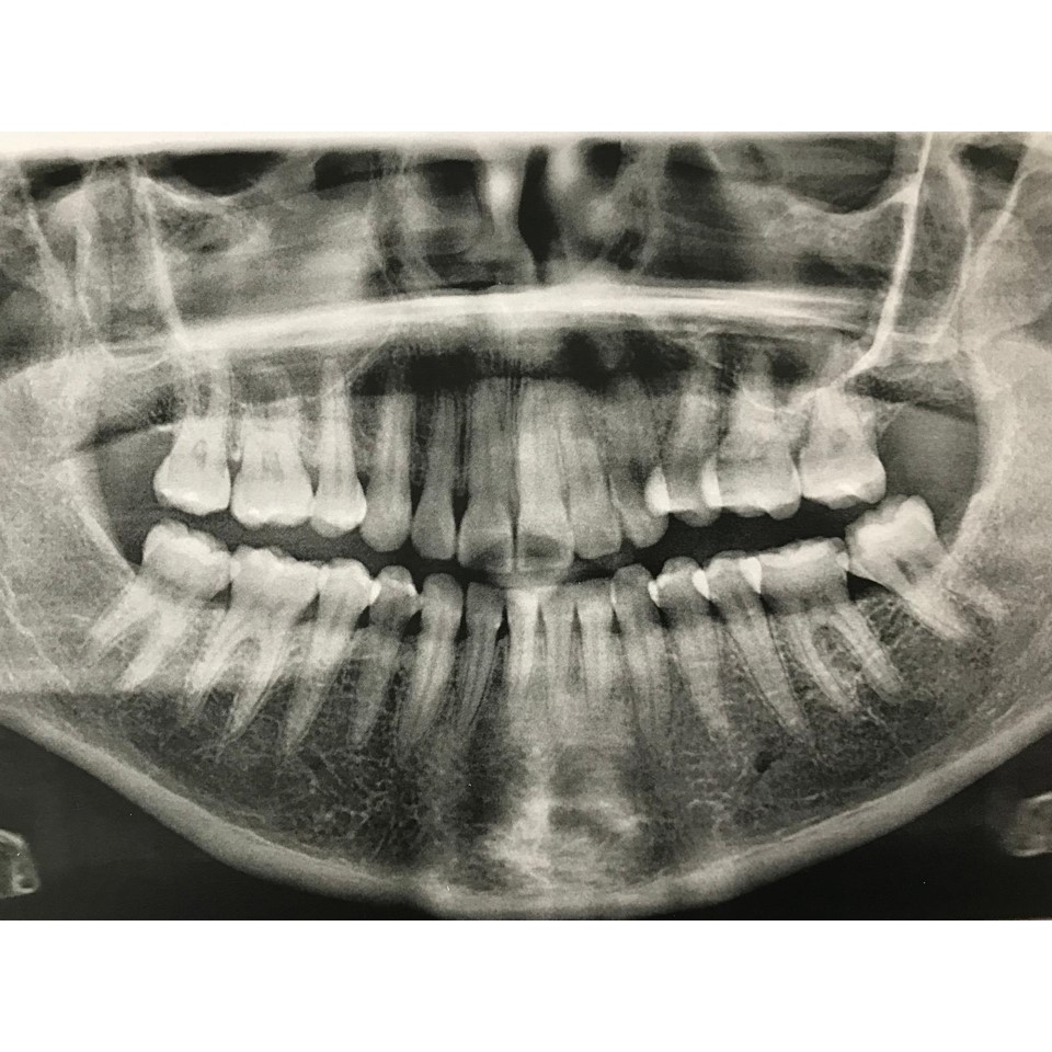 Aligner 1-10 Steps - Image 10