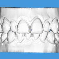 Bleaching Model / STL Model