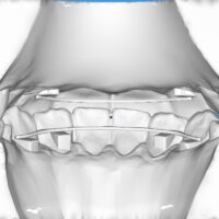 Retainer Wire & Model STL