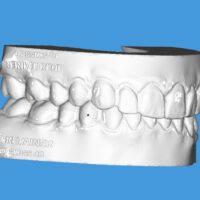 Retainer Splint / STL Model