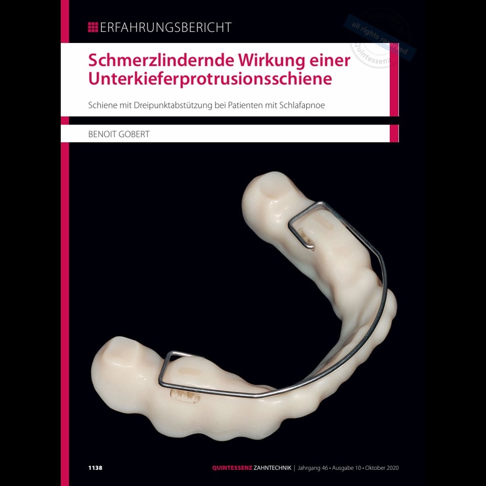 Anti Snoring Splint (Serenight©) – Finished Product - Image 2