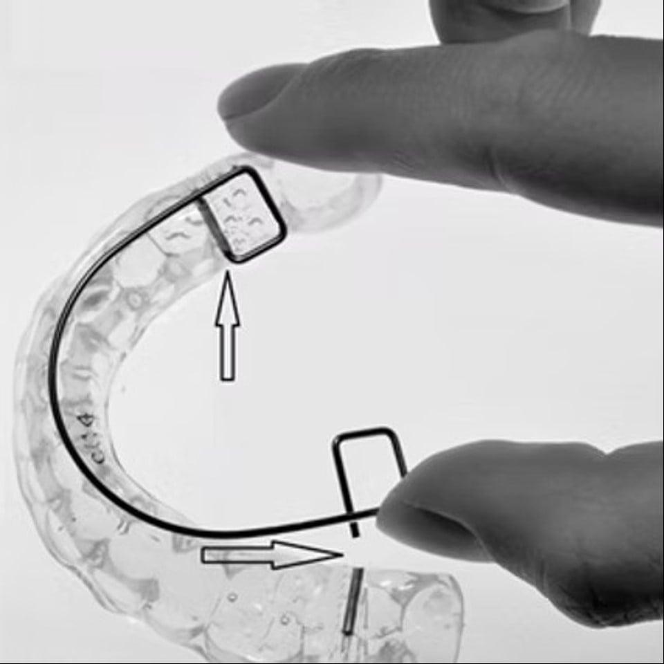 Anti Snoring Splint (Serenight©) – Finished Product - Image 13