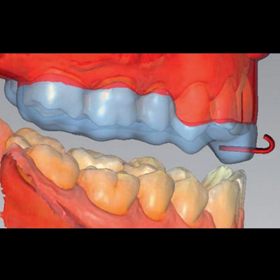 Anti Snoring Splint (Serenight©) – Finished Product - Image 14