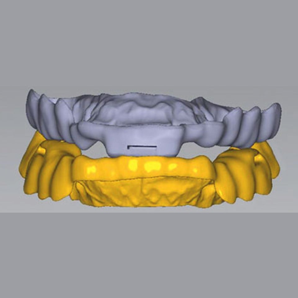Anti Snoring Splint (Serenight©) – Finished Product - Image 16
