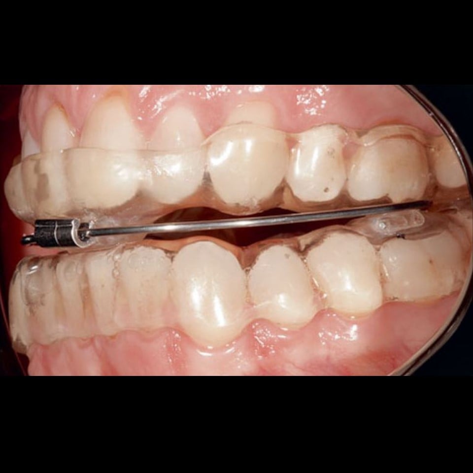 Anti Snoring Splint (Serenight©) – Finished Product - Image 19