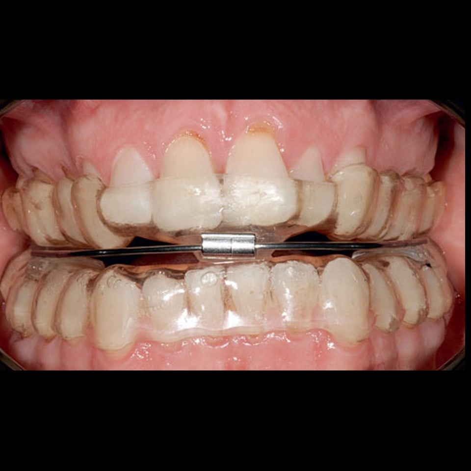 Anti Snoring Splint (Serenight©) – Finished Product - Image 20