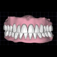 Bimaxillar full denture