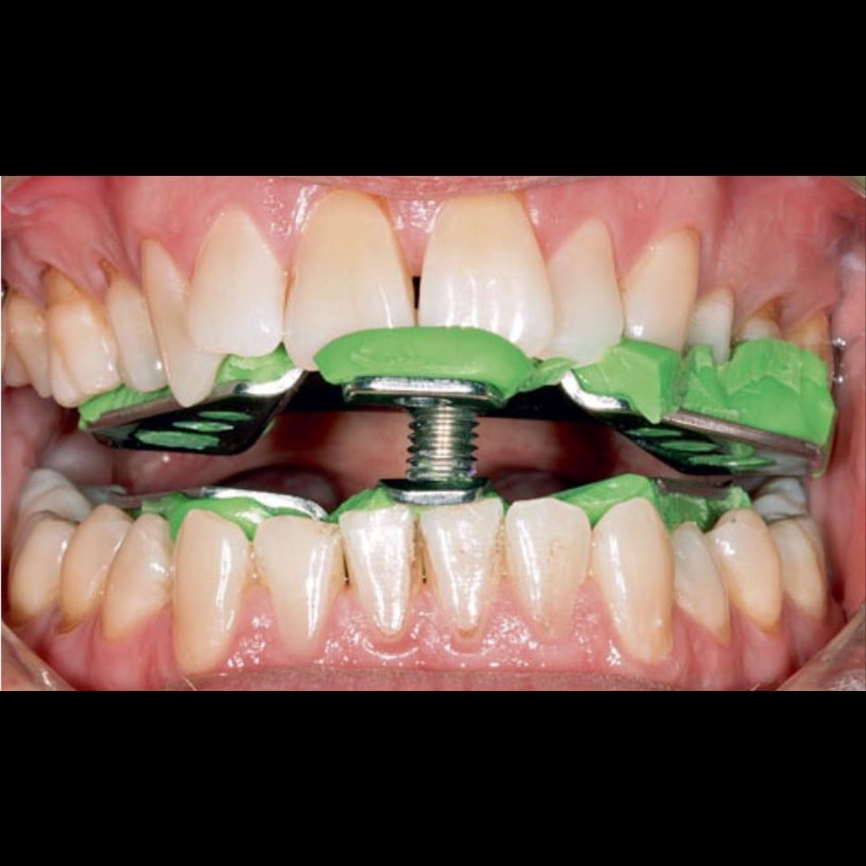Anti Snoring Splint (Serenight©) – Finished Product - Image 5