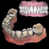 Removable, Partial & Full Dentures
