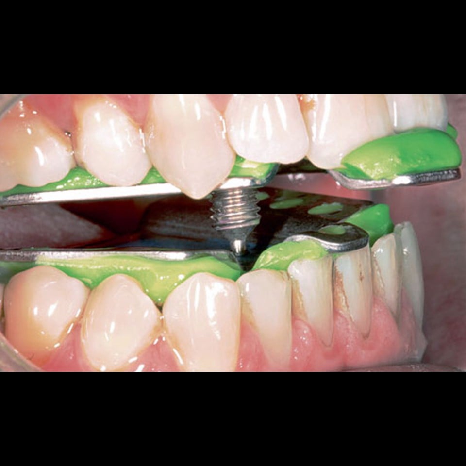 Anti Snoring Splint (Serenight©) – Finished Product - Image 6