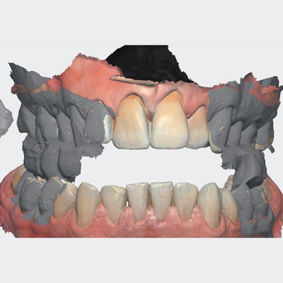 Anti Snoring Splint (Serenight©) – Finished Product - Image 11