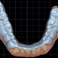 Gerber Anatomic Splint