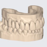 Wax Up Model / Mock Up Model